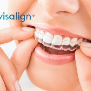 orthodontie-invisible-invisalign_190523140433.1559068955
